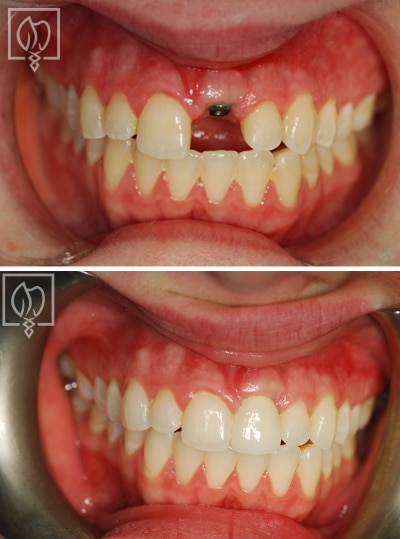 Photo of front tooth replacement with an implant - Elite Prosthetic Dentistry