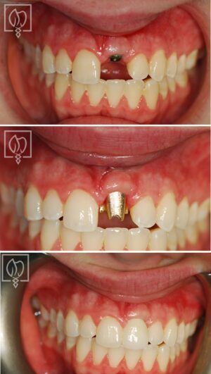 before and after front tooth replacement Washington DC