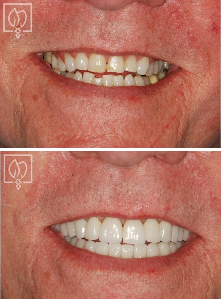 before and after dental crowns smile makeover Bethesda MD