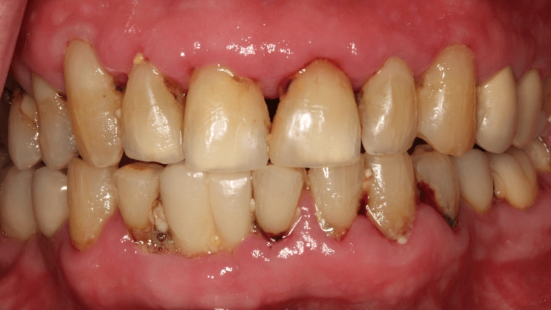 gum disease oral hygiene prosthodontist Washington DC