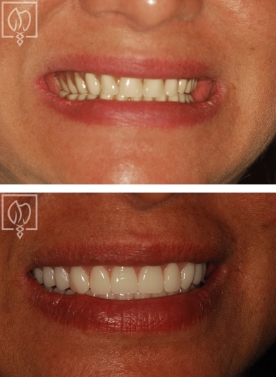 before and after patient overdenture appliance