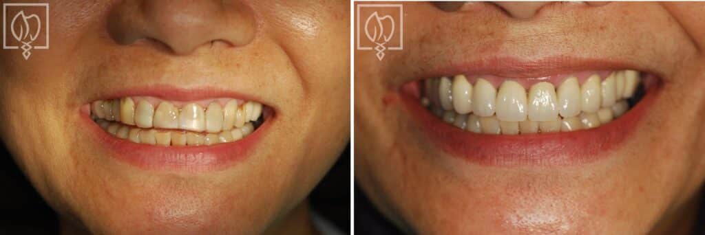 Before and after of a smile transformation and smile makeover