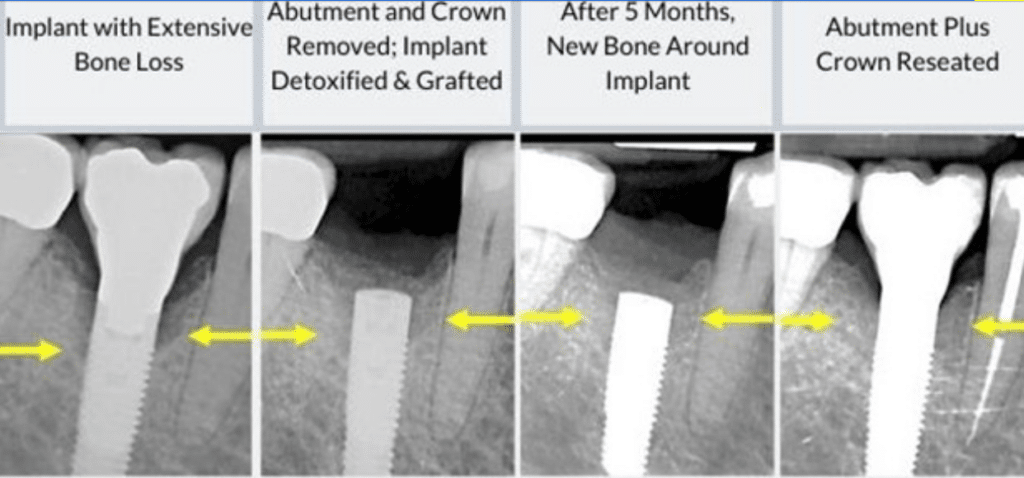 dental implant with bone loss before failing implant restored after Washington DC