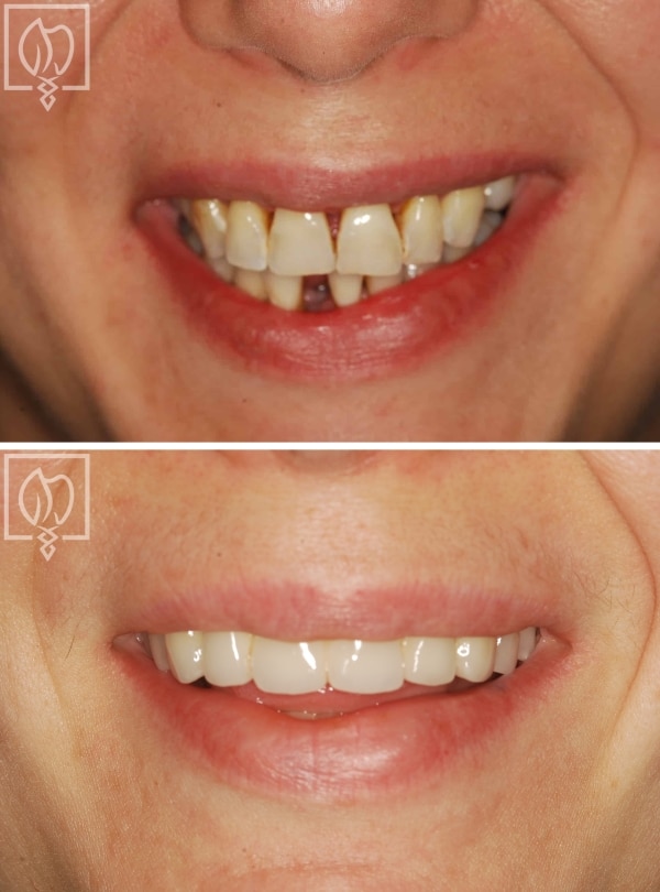 Before after prosthodontist smile makeover patient Washington DC