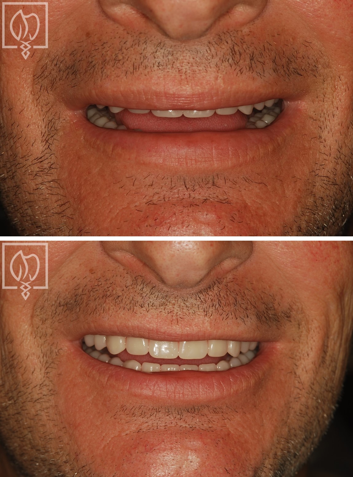 before after smile makeover with dentures Washington DC