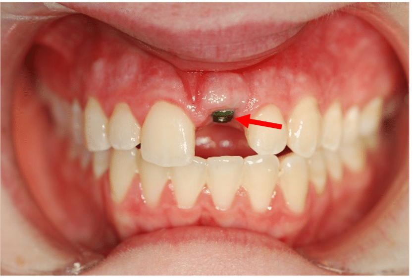Failing Dental Implant - sec3fig1