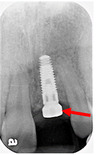 Failing Dental Implant - sec3fig2