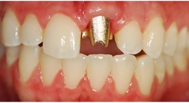 Failing Dental Implant - sec4fig1