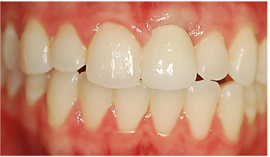 Failing Dental Implant - sec4fig2