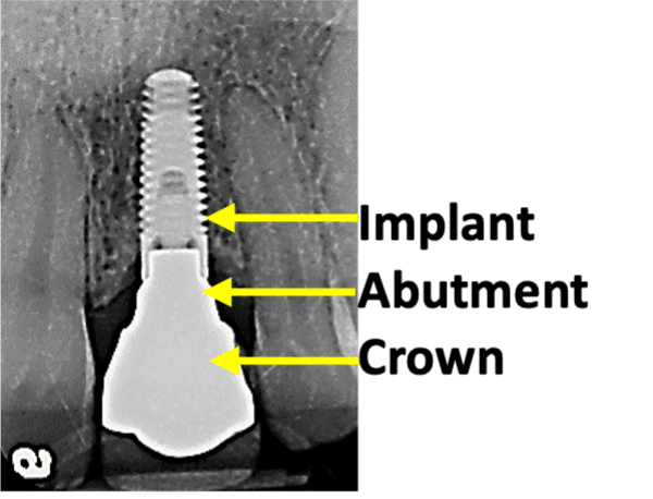 Implant, Abutment, Crown Photo