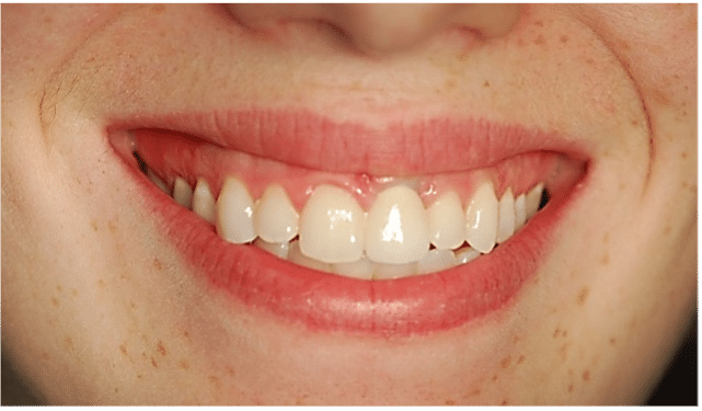 Failing Dental Implant - smile transformation photo