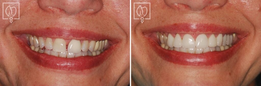 before after patient gap tooth smile makeover Bethesda MD