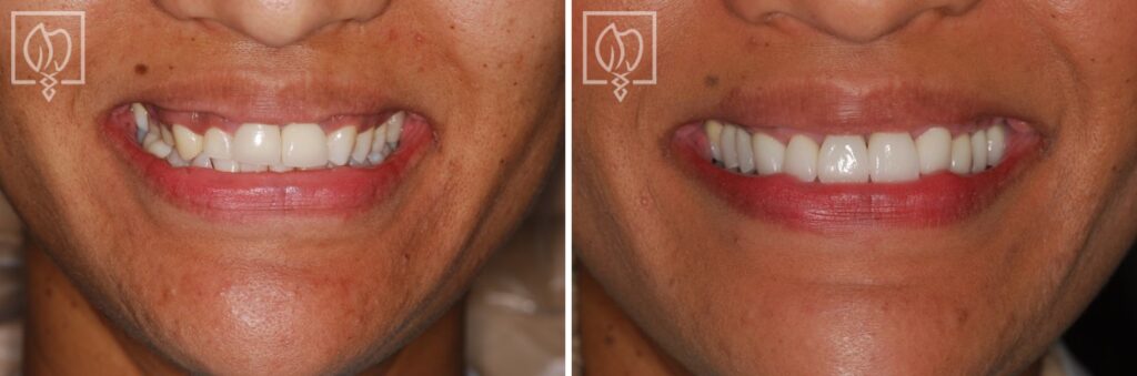 before after patient smile makeover prosthodontist DC