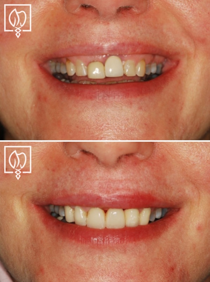Before After immediate smile makeover Bethesda MD