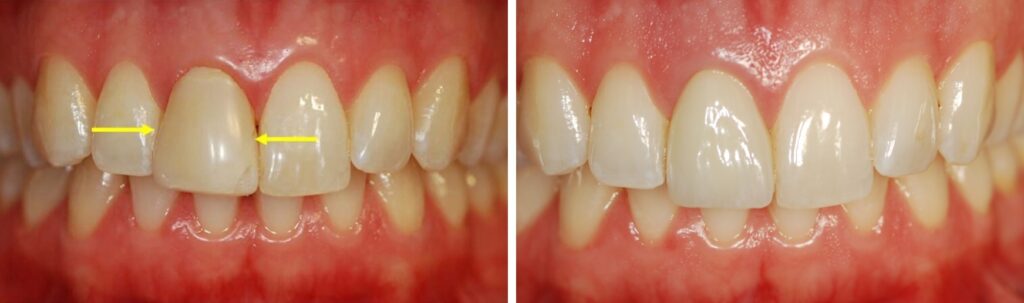 before after dental veneer prosthodontist DC